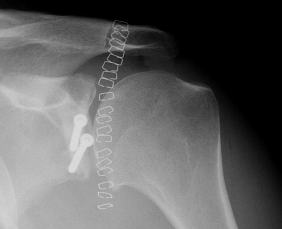 Shoulder Posterior Bony Block0001